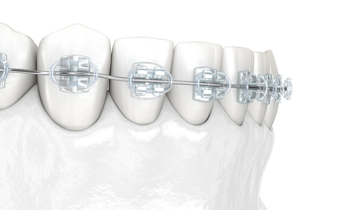 歯科治療で使われる金属のリスク