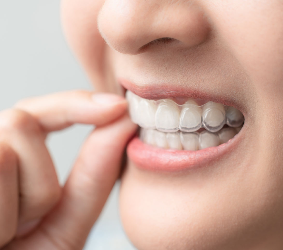 神経まで進行した虫歯