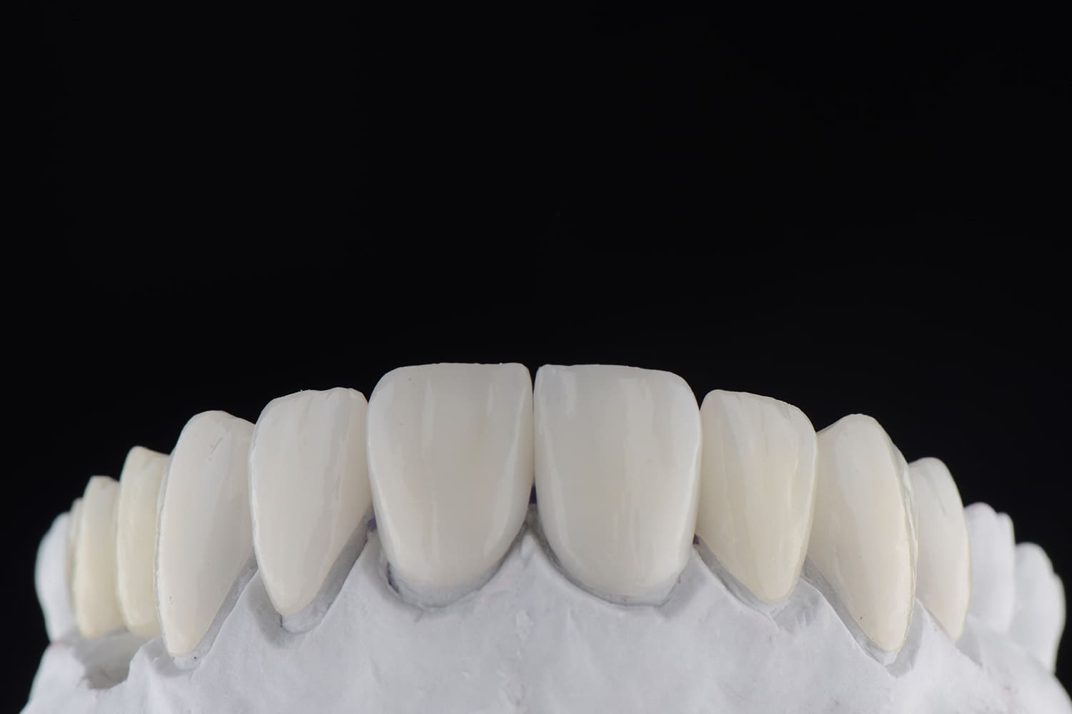 ダイレクトボンディング