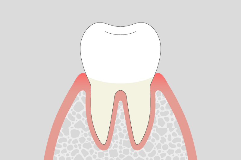 歯肉炎（軽度）