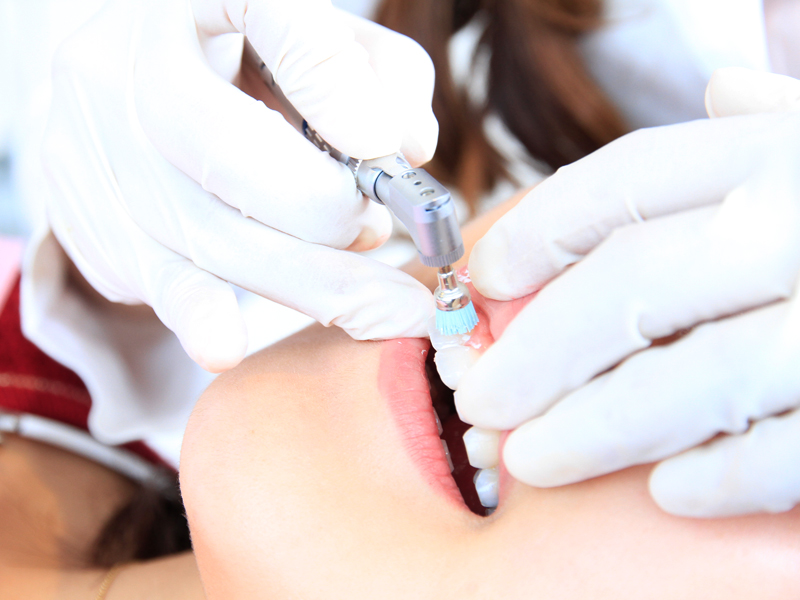 神経まで進行した虫歯